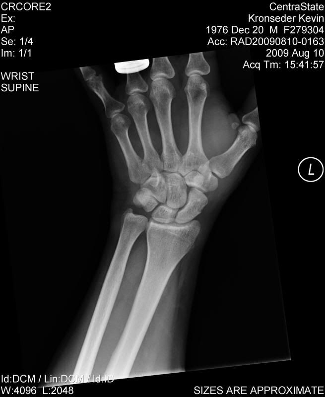 Sprained wrist or scaphoid Health & Fitness ThumperTalk