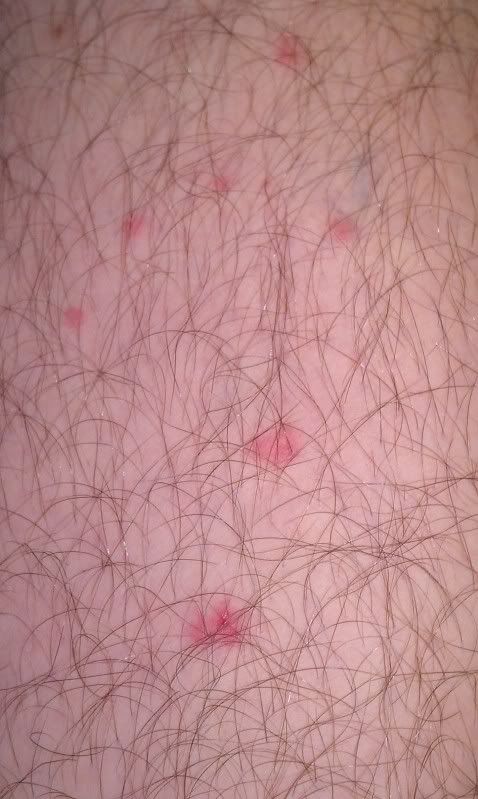 random-red-bumps-on-my-skin-pics-inside-page-1-health-matters